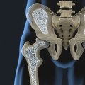 Understanding Bone Density: What You Need to Know